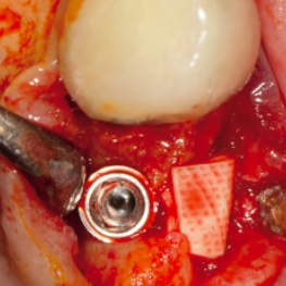Buckle Konturaugmentation ohne KEM Dr. Abundo Implantologie Journal 6/2019