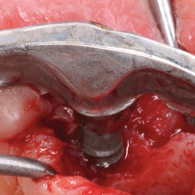 REGEDENT Friedmann Implantologie Journal 3/2019 Clean & Seal