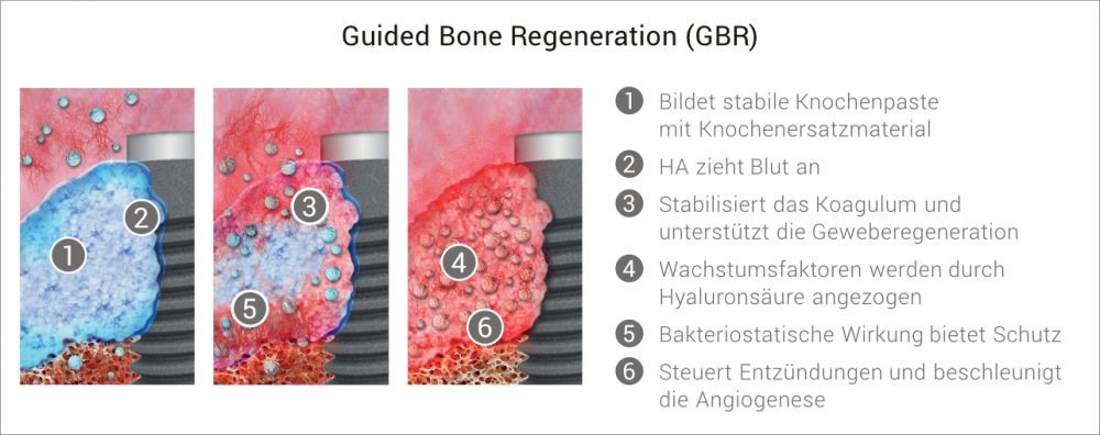 Knochenaugmentation